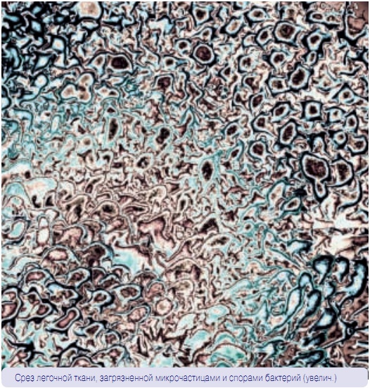 Срез легочной ткани, загрязненной микрочастицами и спорами бактерий (увелич.)
